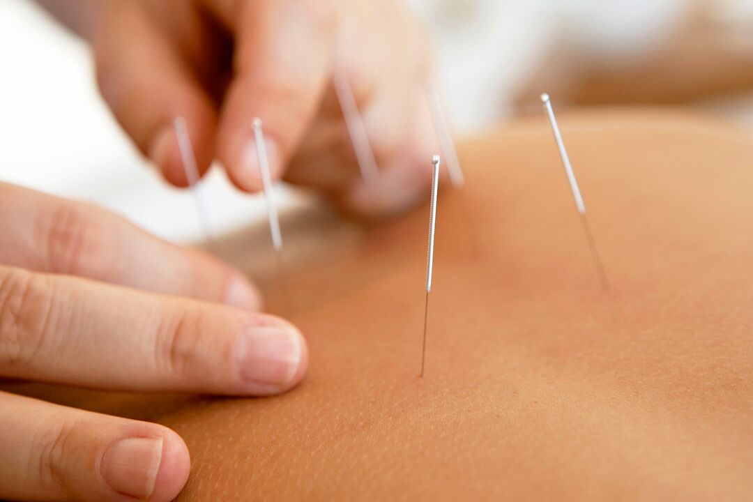 L'acupuncture augmente l'efficacité